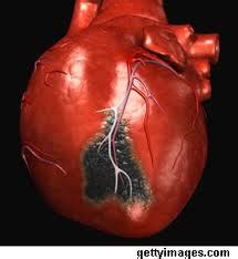 Follow the links above to find out more about the different stemi. Sindroma Koroner Akut PSYCHOLOGYMANIA