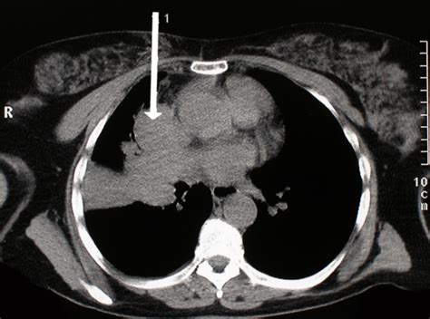 Axial Ct Image Demonstrating The Right Hilar Mass Extending Into The