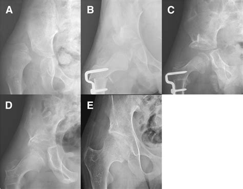 Use Of Iliac Crest Allograft For Dega Pelvic Osteotomy In Patients With