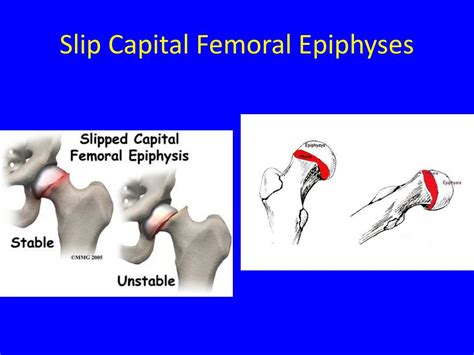 Ppt Slipped Capital Femoral Epiphysis Scfe Powerpoint Presentation