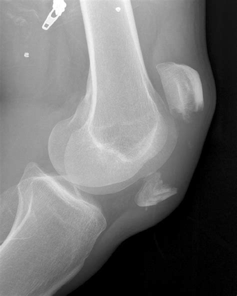 Patella Fractures And Injuries To The Knee Extensor Mechanism