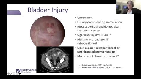 Holmium Laser Enucleation Of The Prostate HOLEP For BPH YouTube