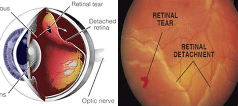 We did not find results for: Detached Retina - Can It Be Prevented?