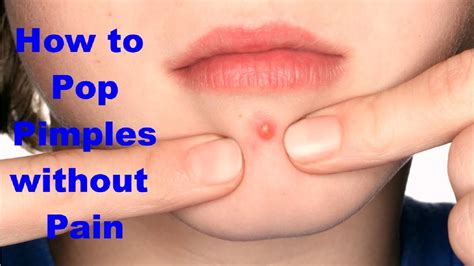 How To Pop Pimples Without Pain With Home Remedies Pop A Pimple