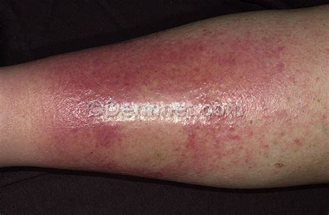 Cellulitis Medical Pictures Info Health Definitions Photos