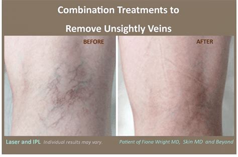 Using Lasers To Treat Varicose And Spider Veins Butex Medical Spa And