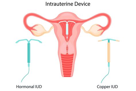Intrauterine Device Everything To Know About The Contraceptive Coil Iud Including Side Effects