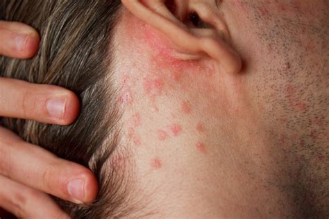 Celiac Disease Rash Dermatitis Herpetiformis Explained Good For You