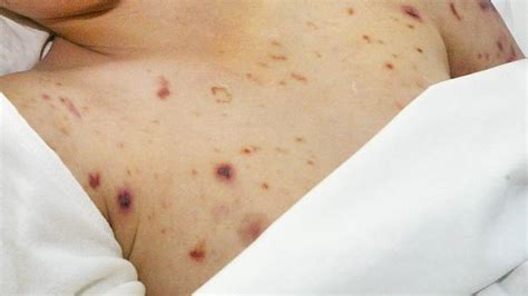 A Sixth Case Of Meningococcal Has Been Diagnosed In Queensland The