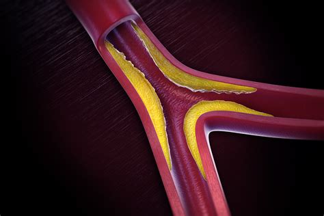 Overview Of Peripheral Artery Disease