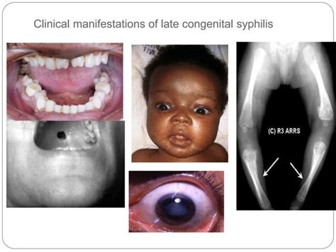 Congenital Syphilis Arire