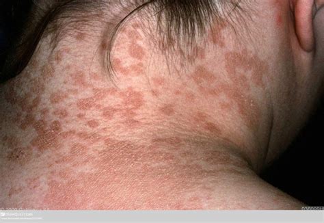 Tinea Versicolor Skin Symptoms Cause Pictures And Treatment