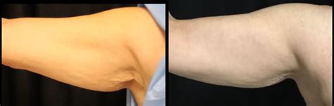 Thermage And Coolsculpting Arms 6 Months Before And After