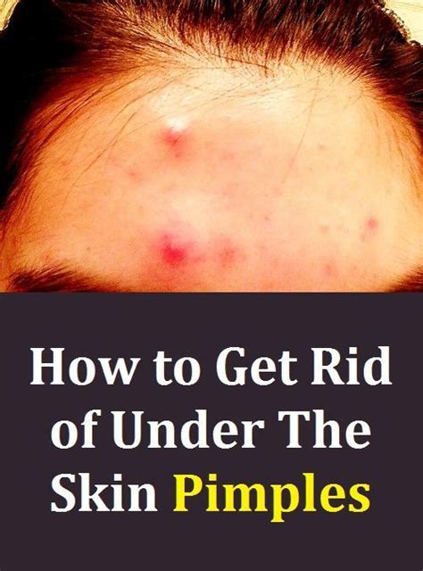 How To Get Rid Of Under The Skin Pimples Pimples How To Get Rid How