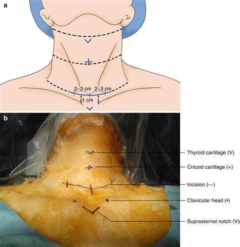 Open Thyroidectomy Basicmedical Key