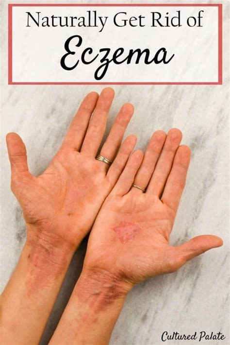 How To Get Rid Of Eczema Naturally With Images Get Rid Of Eczema