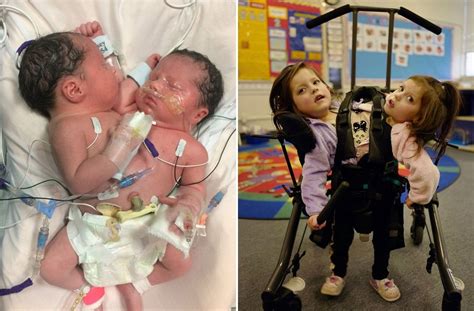 conjoined twins ‘defy odds by learning to walk and starting school metro news