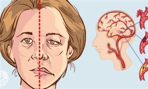 A Week Before Strokeyour Body Will Warn You With These 10 Signals