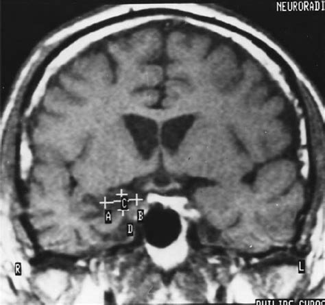 Mri Scan Coronal Sections At A Level Showing The Amygdala From The