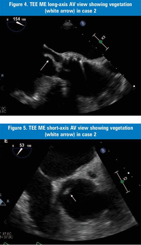 Figure 5 From Prosthetic Aortic Valve Endocarditis Following