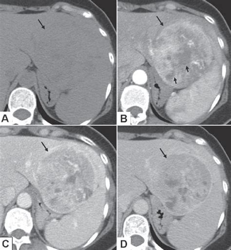 Dynamic Three Phase Ct Scan Of The Liver A Non Contrast Image