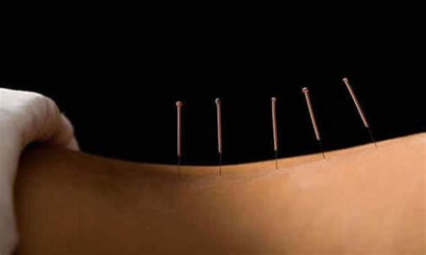What is acupuncture ? – Affordable Acupuncture