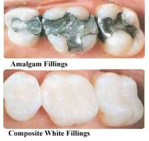 Tooth Filling In Dhwanil Dental Clinic Dhwanil Dental Clinic In