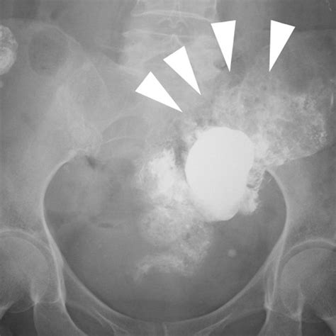 Postoperative Ct Shows Residual Barium In The Intraperitoneal And