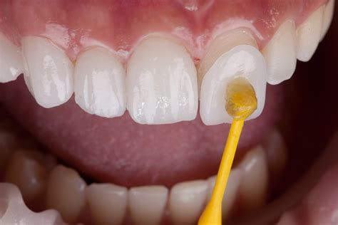 The Pros And Cons Of Dental Veneers