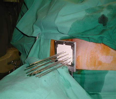 High Dose Rate Interstitial Brachytherapy As Monotherapy In One Fraction For The Treatment Of
