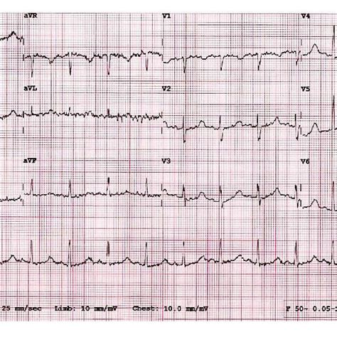 ECG This ECG Strip Is Showing Sinus Rhythm With Prolonged QT Interval