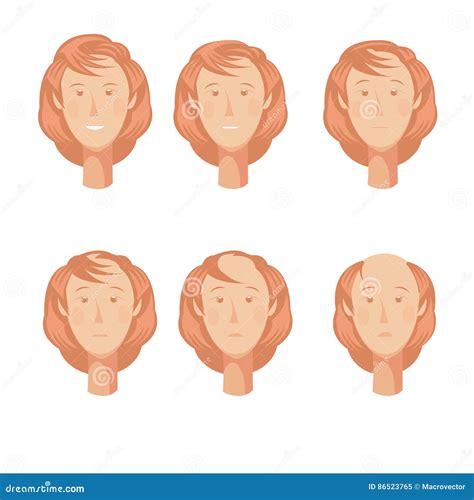 Balding Woman Heads Set Stock Vector Illustration Of Anatomical 86523765