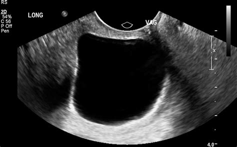 Cervical Stenosis Causing Haematocervix And Haematometra In A