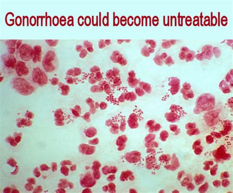 Medical Laboratory And Biomedical Science Gonorrhoea Could Become