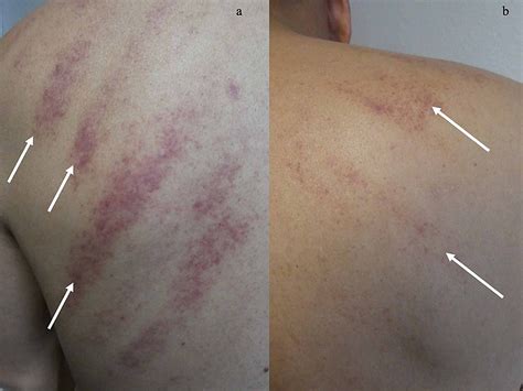 Cureus New Onset Of Linear Purpura On The Back Coining Therapy