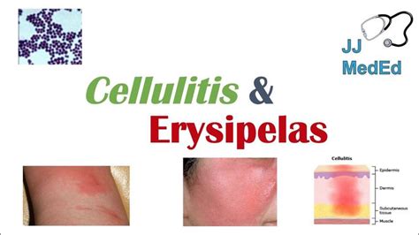 Cellulitis Vs Erysipelas Bacterial Causes Risk Factors Signs And
