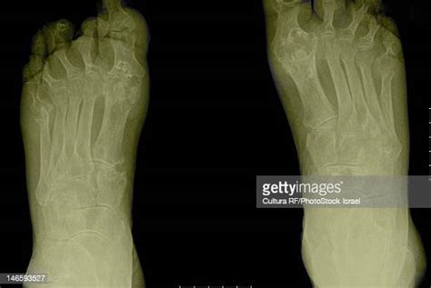 Rheumatoid Arthritis Feet Photos And Premium High Res Pictures Getty