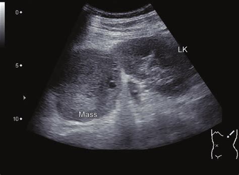 Renal Mass Ultrasound