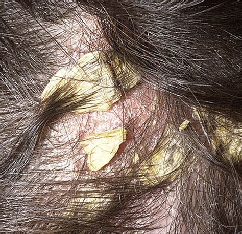 Itchy Spot On Scalp Pictures Photos