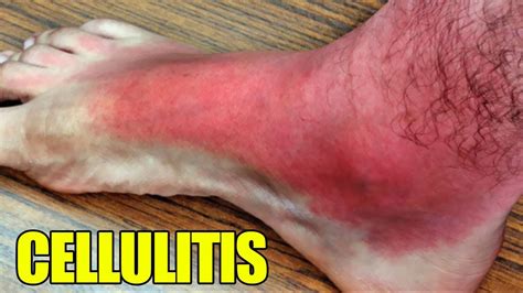 Cellulitis Complicated Cellulitis Infections And Abscesses Youtube