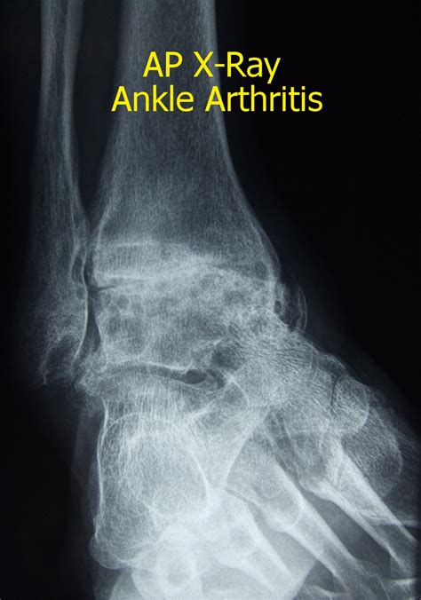 Ankle Arthritis — Stanmore Foot And Ankle Surgery