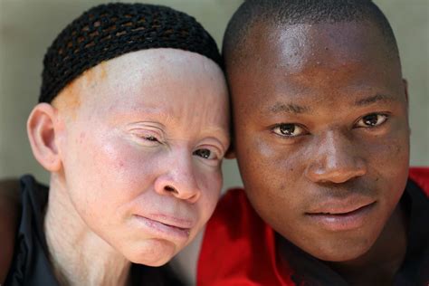 Ser Una Persona Con Albinismo No Es Igual En Europa Que En África