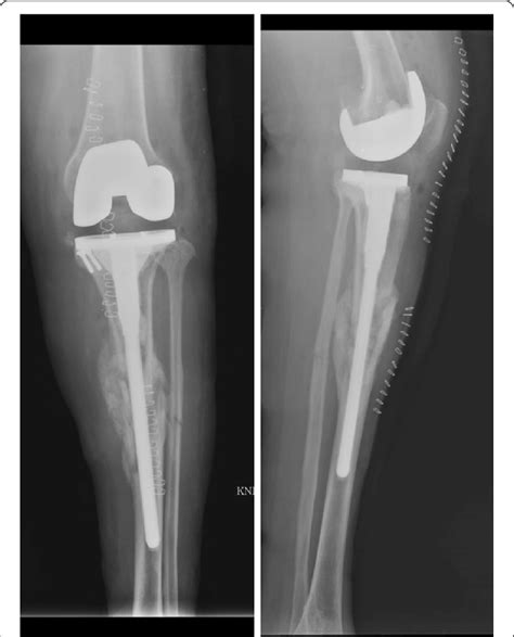 Postoperative Radiograph Of Case 1 Patient Showing Total Knee