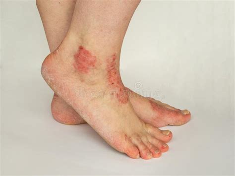 Closeup Of Psoriasis On Knee Stock Photo Image Of Dermatology
