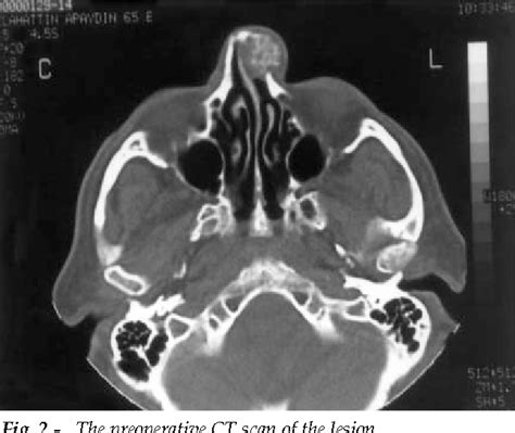 Figure 2 From Hemangioma Of The Nasal Bone A Case Report Semantic