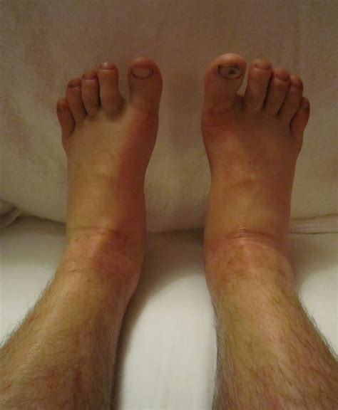 Bilateral Ankle Edema Causes When Tests Are Normal Scary Symptoms