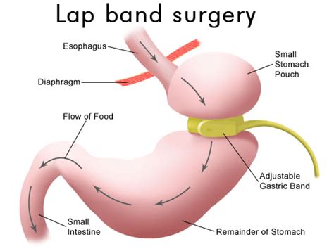 Lap Band Surgery In Tijuana Mexico Mx Bariatrics