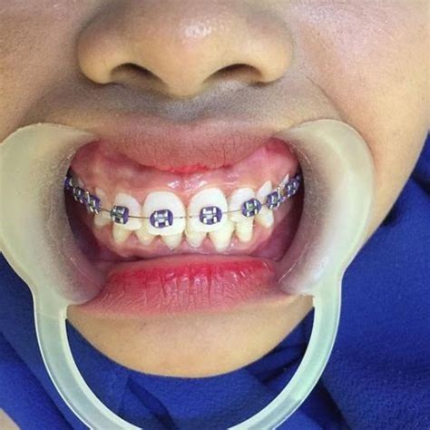 Pin By John Beeson On Orthodontic Braces In Teeth Braces Braces Colors Orthodontics Braces