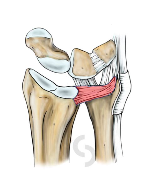 Triangular Fibrocartilage Complex Tfcc Tear