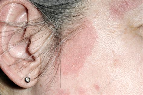 Seborrheic Dermatitis Stock Image C0580815 Science Photo Library